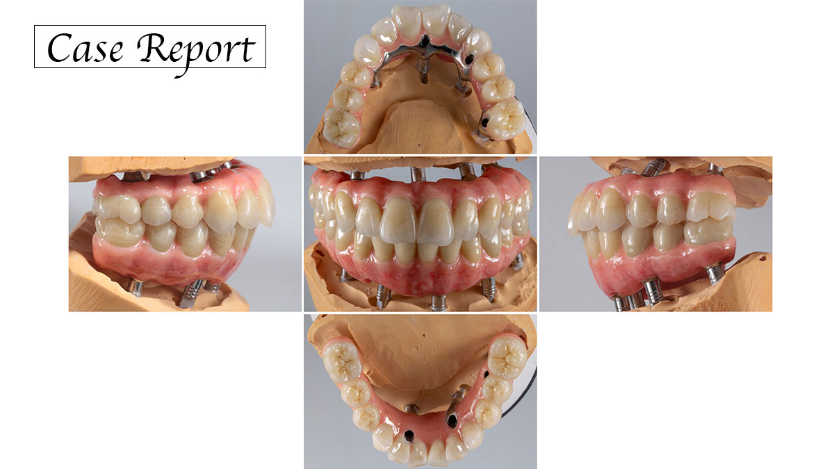 ショートアーチのImplant Fixed Bridgeを用いた咬合再構成の症例の画像です