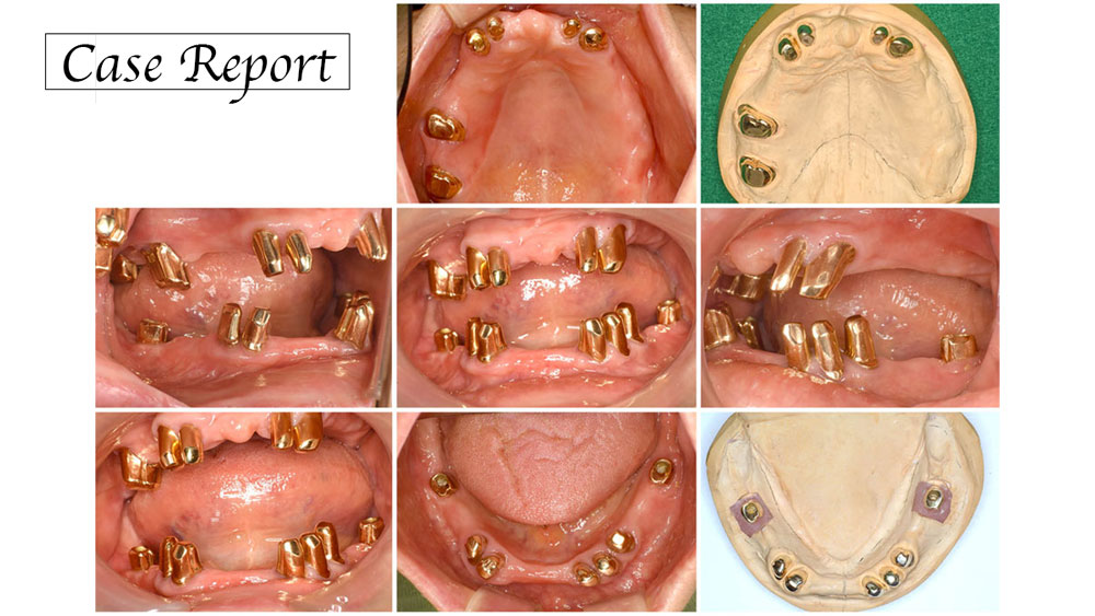 重度歯周炎に罹患した顕在的病的咬合患者に対し、上下顎コーヌスデンチャーを用いて咬合再構成を行った一症例の画像です