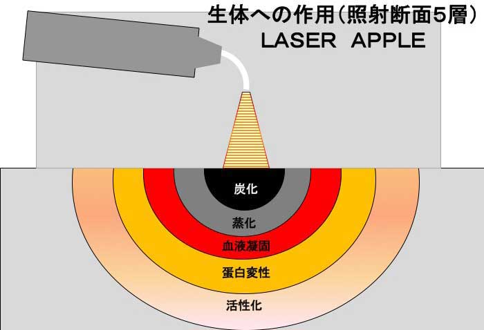 歯科用レーザー総論「レーザーとは」