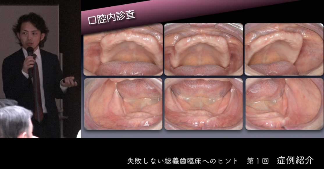 失敗しない総義歯臨床へのヒント 第1回『症例紹介』
