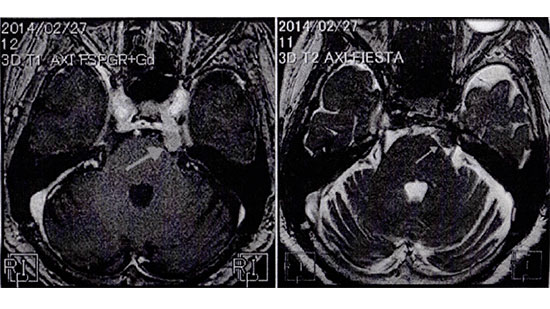 脳腫瘍の患者が最初に歯科を受診する!?-口腔顔面痛への理解の必要性-