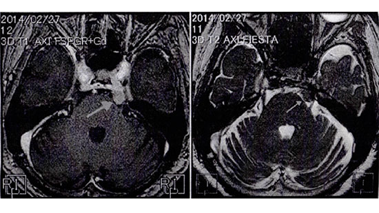 脳腫瘍の患者が最初に歯科を受診する！？－口腔顔面痛への理解の必要性－の画像です