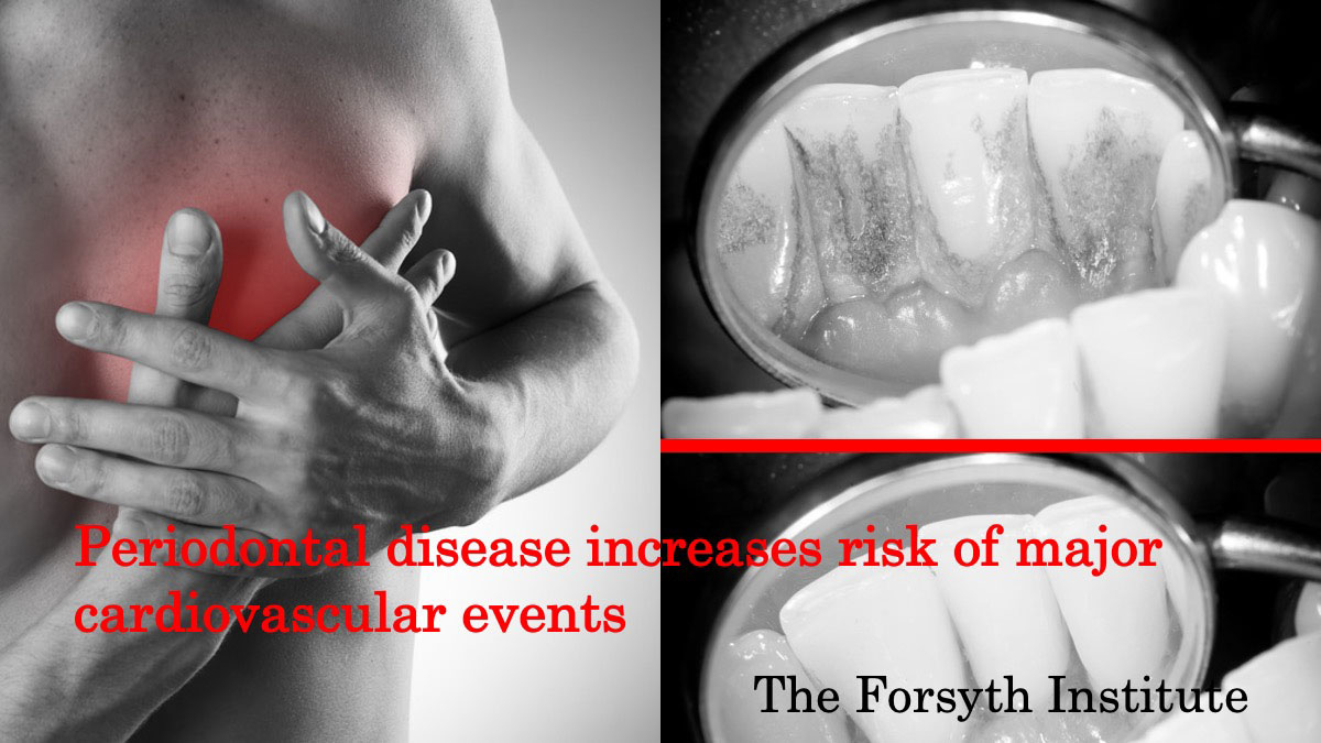 歯周病による心疾患リスク向上についての新発見　米国の画像です