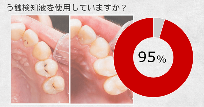 う蝕検知液の使用頻度-現役歯科医の9割が使用していると回答