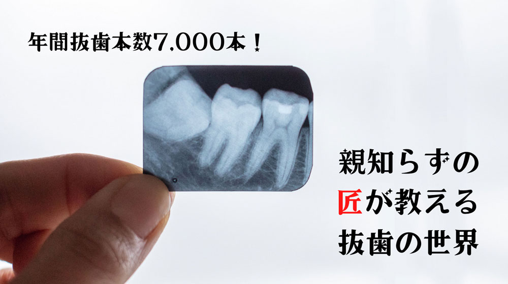 年間抜歯本数7000本! 親知らずの匠が教える抜歯の世界①「ホントは知らない親知らず」の画像です