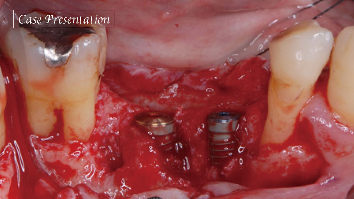 高度に吸収した顎堤に対し、骨造成を応用しインプラント修復を行った症例の画像です