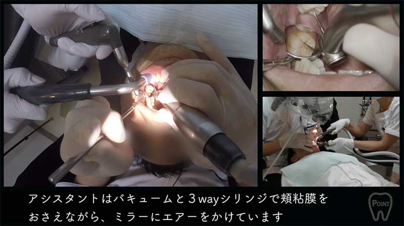 【顕微鏡歯科入門】ポジショニングとアシスタントワーク 第3回 左下臼歯部の画像です
