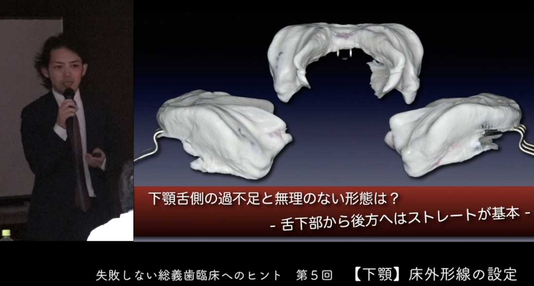 失敗しない総義歯臨床へのヒント 第5回『下顎床外形線の設定』