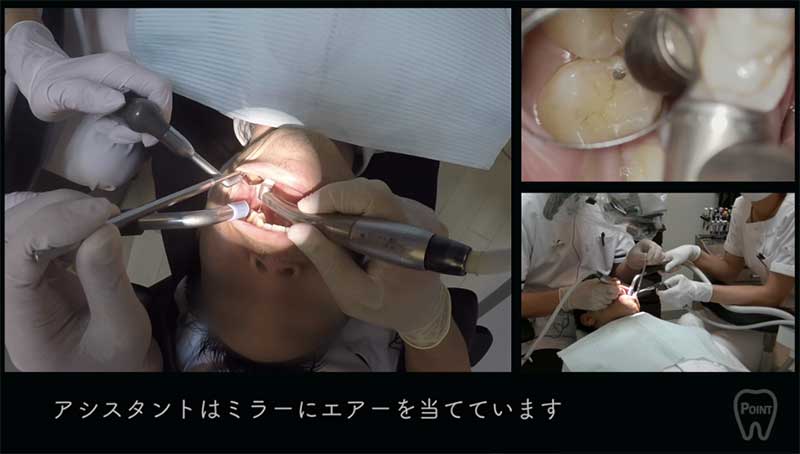 【顕微鏡歯科入門】ポジショニングとアシスタントワーク 第2回 左上臼歯部の画像です