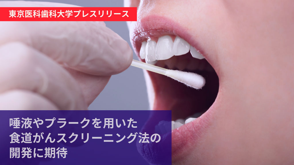 特定の口腔内細菌が食道がんのリスクファクターになることが明らかに 東京医科歯科大学の画像です