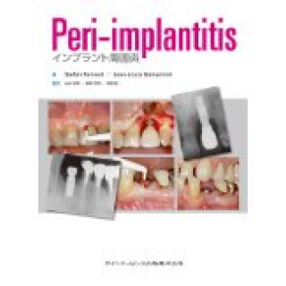 Peri-implantitis インプラント周囲炎の画像です
