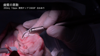 歯科用レーザー各論 第3回「Er:YAGレーザー」