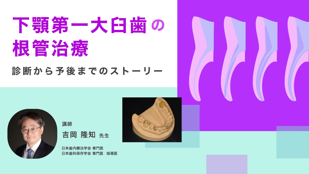 下顎第一大臼歯の根管治療 〜診断から予後までのストーリー〜の画像です