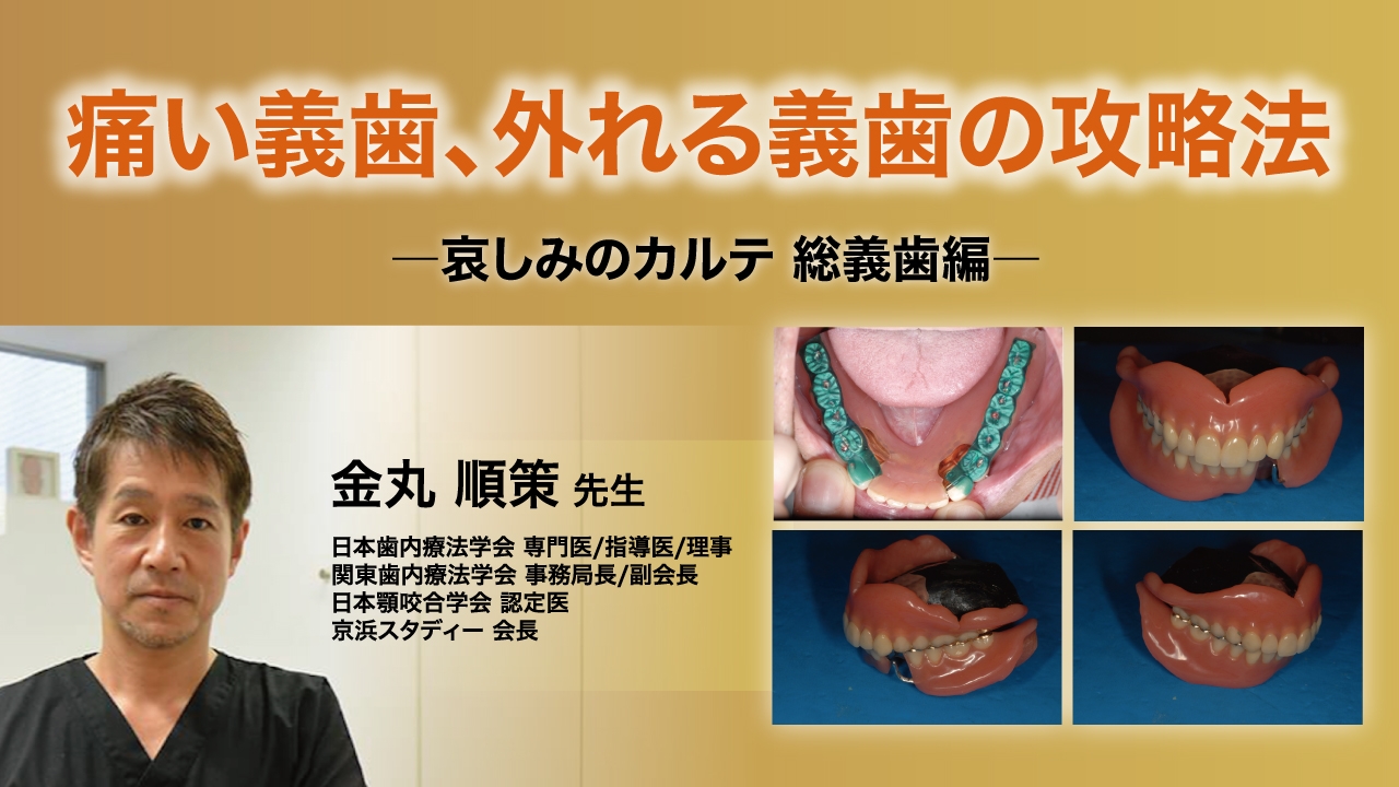痛い義歯、外れる義歯の攻略法〜哀しみのカルテ 総義歯編〜の画像です