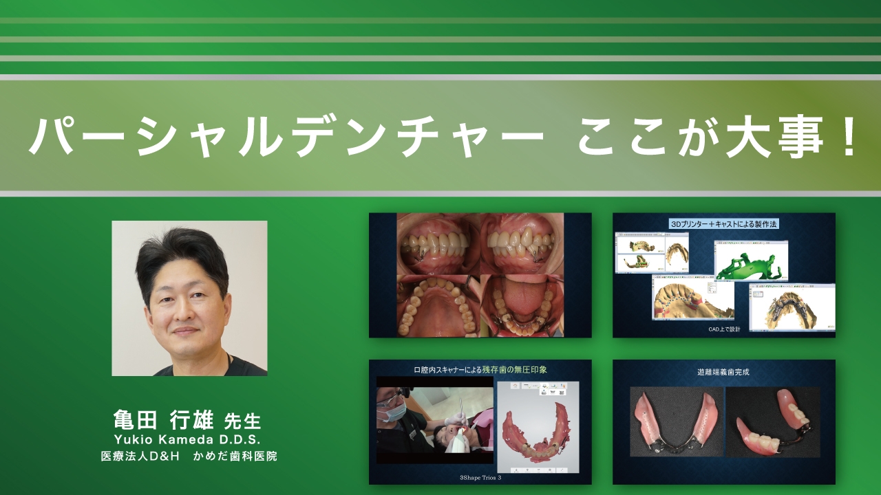 パーシャルデンチャー ここが大事!の画像です