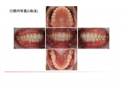 口腔内写真5枚法