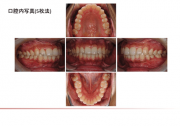 口腔内写真5枚法