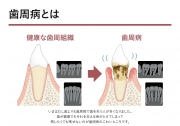 歯周病とは
