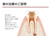 根管治療同意書②