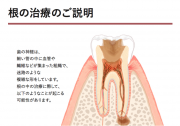 根管治療同意書②
