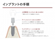 インプラントの手順