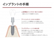 インプラントの手順