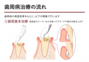 歯周病の治療の流れ