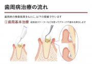 歯周病の治療の流れ