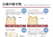 臼歯の被せ物
