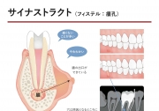サイナストラクト(フィステル・瘻孔)