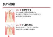根の治療の説明