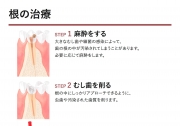 根の治療の説明