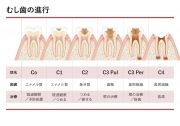 むし歯の進行