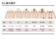 むし歯の進行