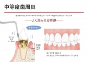 中等度歯周炎