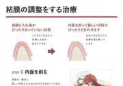 粘膜調整