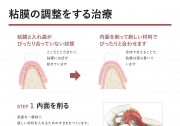 粘膜調整