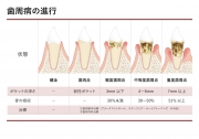 歯周病の進行