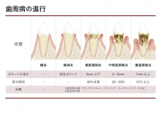 歯周病の進行