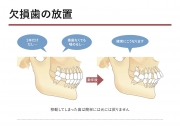 欠損歯の放置