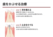 被せる治療の説明