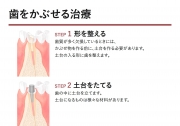 被せる治療の説明