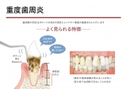 重度歯周炎