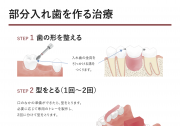 部分入れ歯を作る治療
