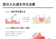 部分入れ歯(パーシャルデンチャー)を作る治療