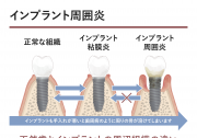 インプラント周囲炎