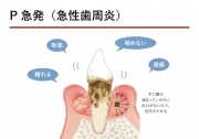 P急発(急性歯周炎)