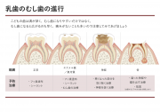 乳歯のむし歯の進行