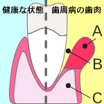 歯周ポケット