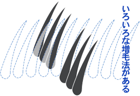 いろいろな増毛法がある